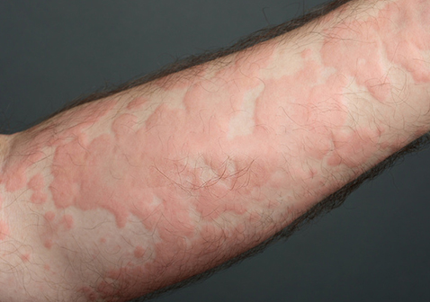 手臂荨麻疹风疹块症状图片