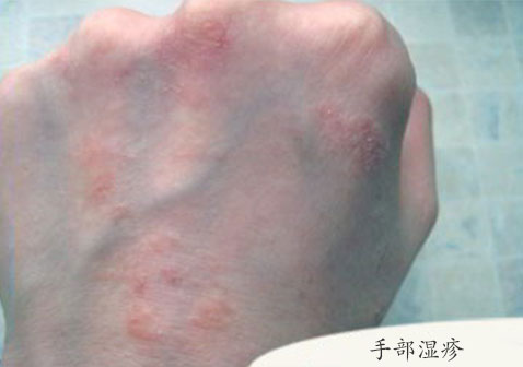 手背湿疹早期症状图片