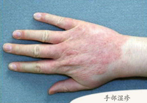 手背湿疹早期症状图片