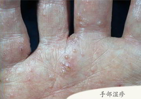 手掌湿疹早期症状图片