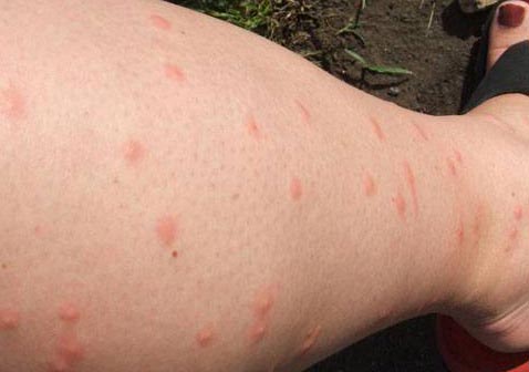腿上出现红色皮疹斑块是什么病