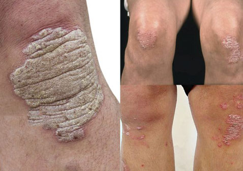 膝盖银屑病各种形式图片